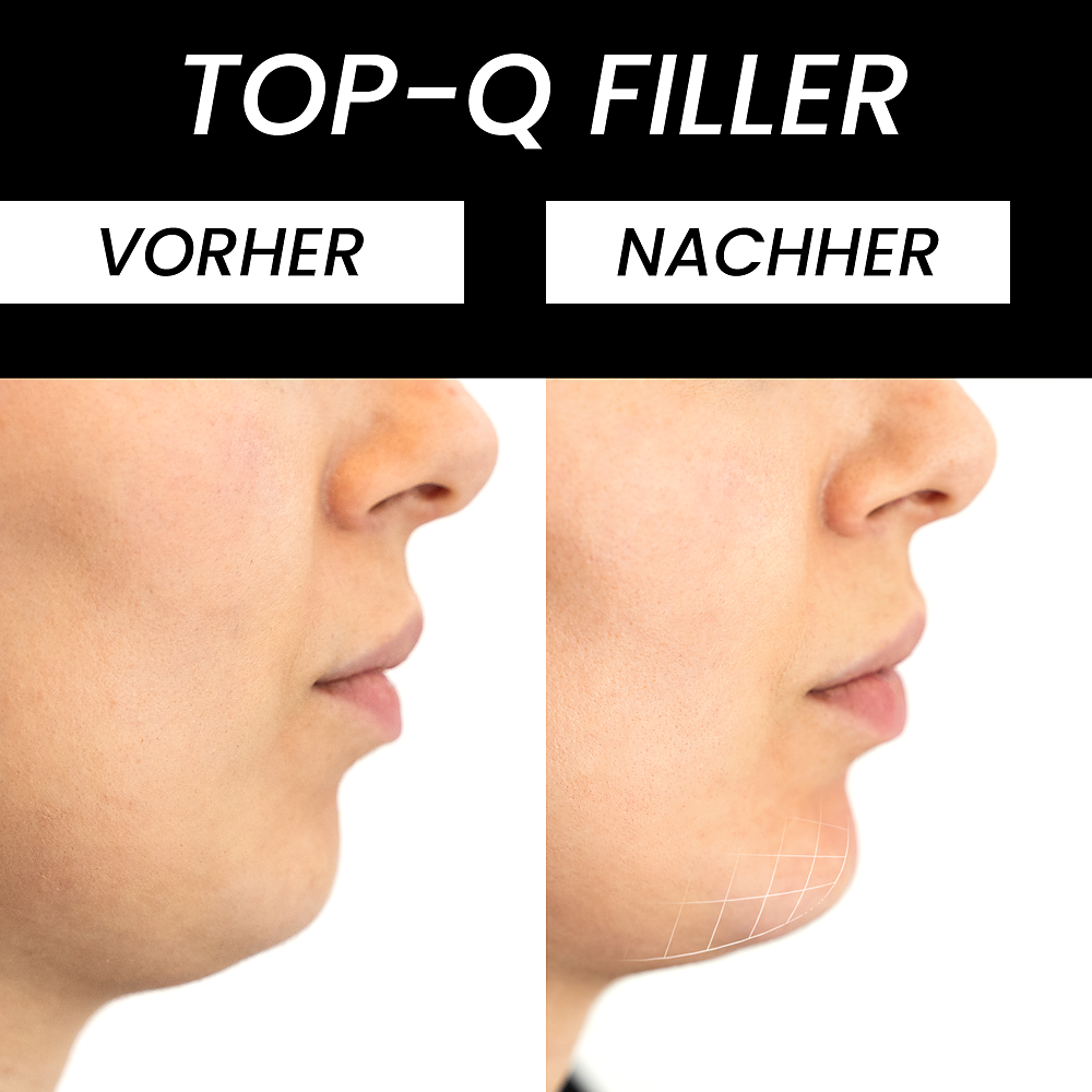 Voor en na vergelijking van hyaluronzuurbehandeling